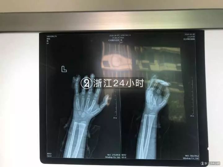 嚇哭！6歲男孩被夾斷手指 罪魁禍?zhǔn)拙故切７? oldsrc=