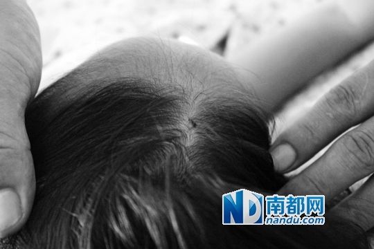 女童頭上被扎的針孔（圓圈處）。賈先生說，被扎不到三秒鐘，女兒就昏了。